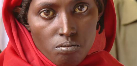 Zeinab-Ibrahim-Mycetoma-Patient-DNDi-2017